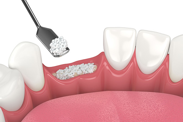 Bone Grafting