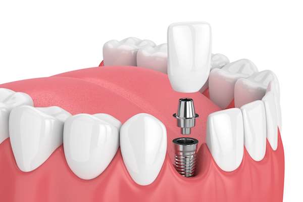 Sufficient Bone Density