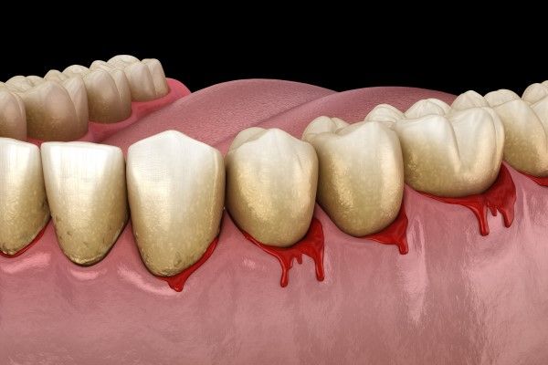 Periodontal Health