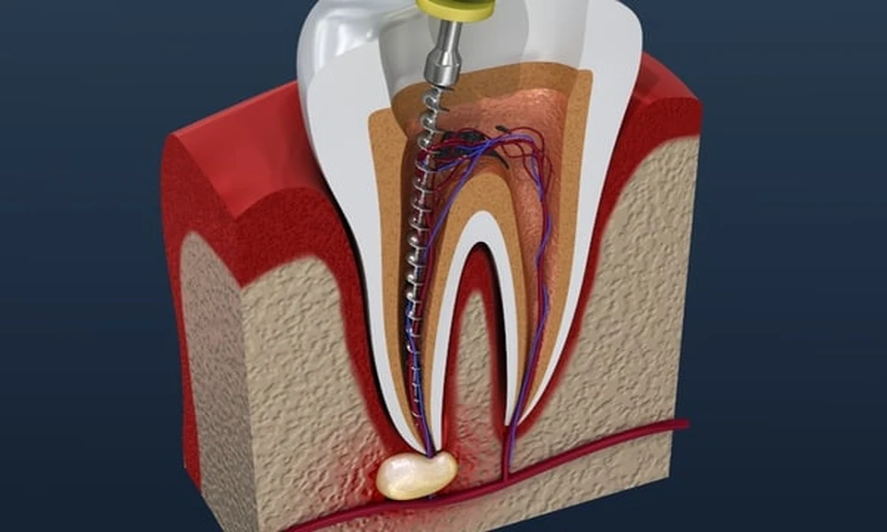 Missing Teeth No More: A Complete Guide to Choosing Dental Implants in Oklahoma City for Lasting Results